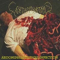 Contagionectomy - Abdominal Surgical Infection (EP)